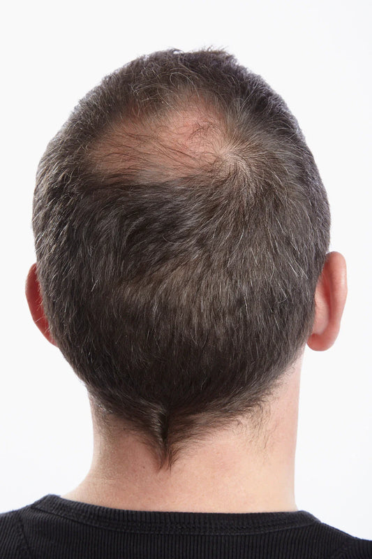 Thickening the crown area